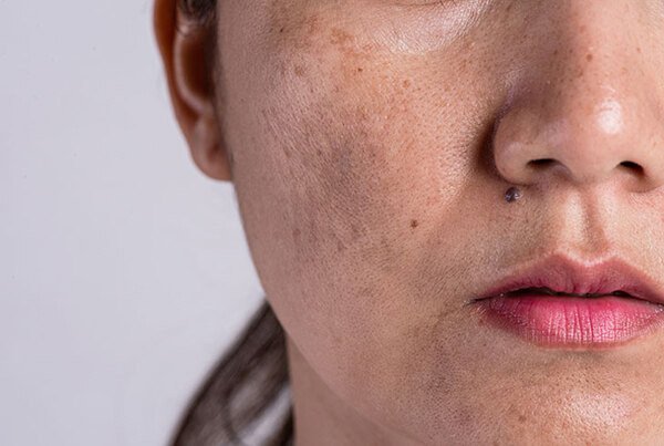 Chế độ ăn uống cân bằng giúp cải thiện nám da và giảm tăng sắc tố da
