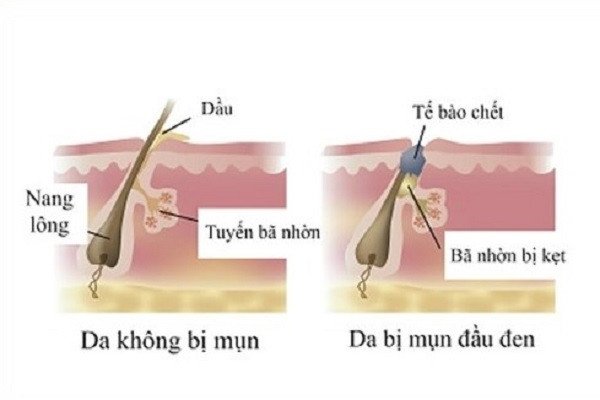Lỗ chân lông bị bít tắc là nguyên nhân chính gây ra mụn đầu đen