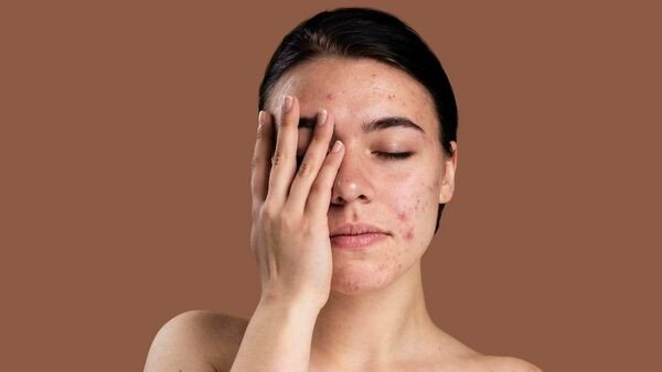 Lựa chọn BHA phù hợp cho làn da mới bắt đầu