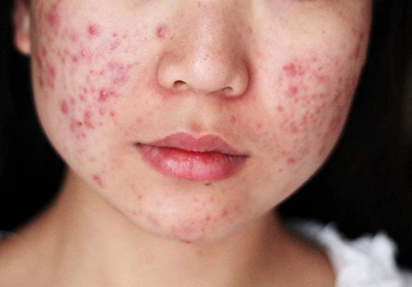 Vết sẹo sau khi nặn mụn viêm