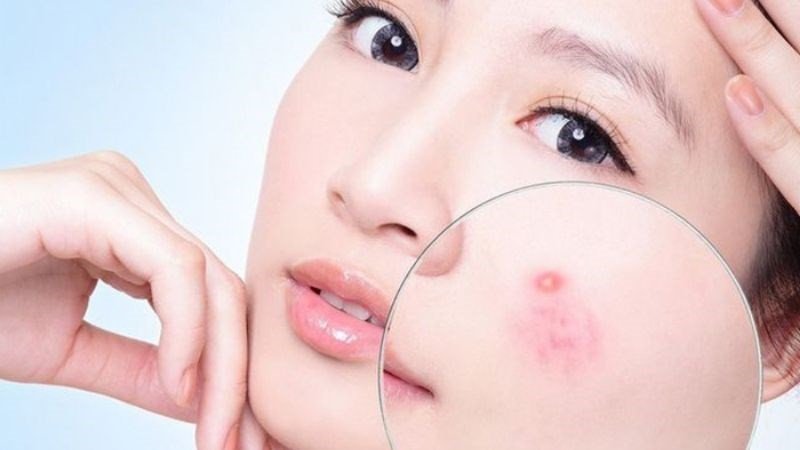 Ăn khoai mì không gây nổi mụn cho da