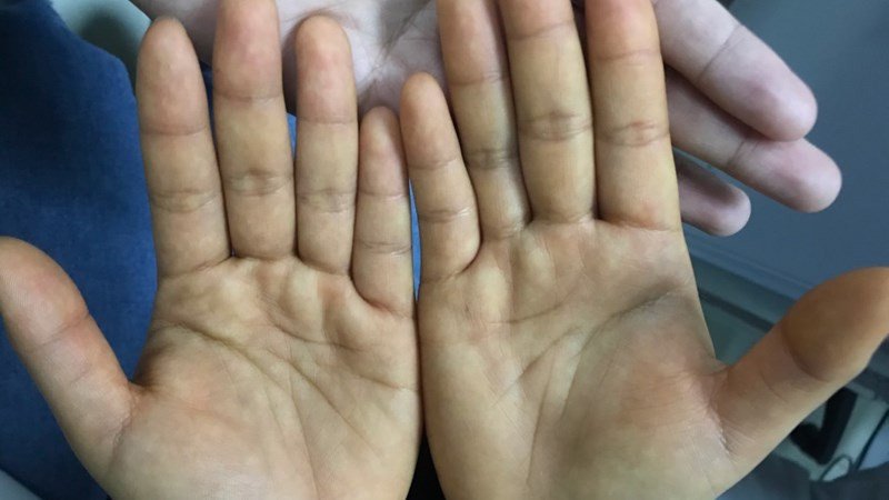 Ảnh hưởng khi ăn quá nhiều đu đủ, đu đủ xào bao nhiêu calo