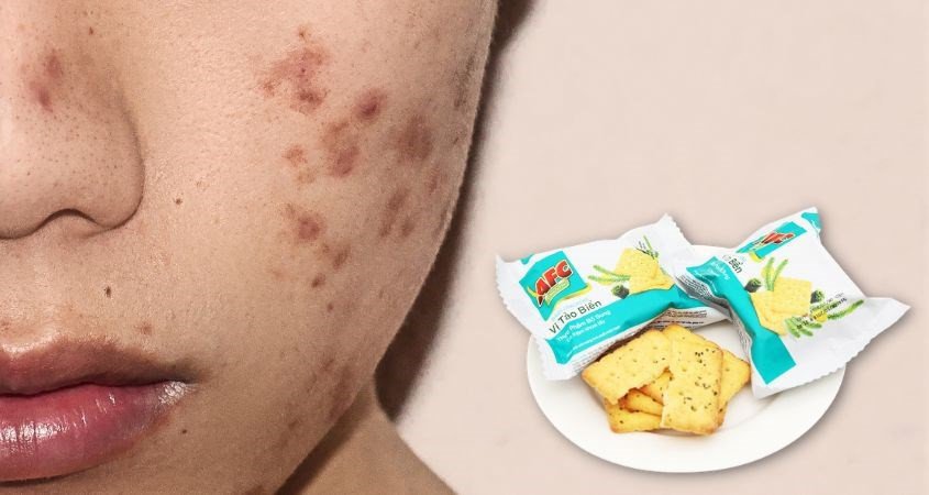 Bánh AFC không gây nóng trong người hay nổi mụn cho người dùng thông thường