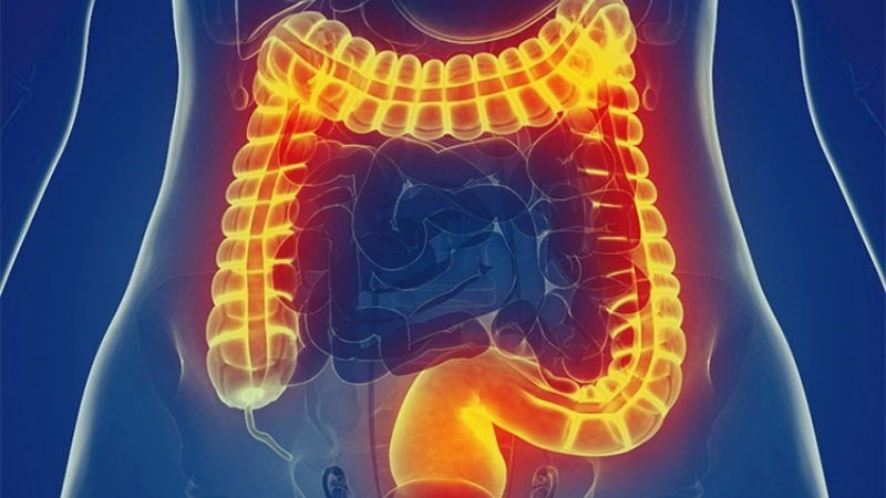 Bệnh nhân bị hội chứng ruột kích thích không nên ăn kim chi