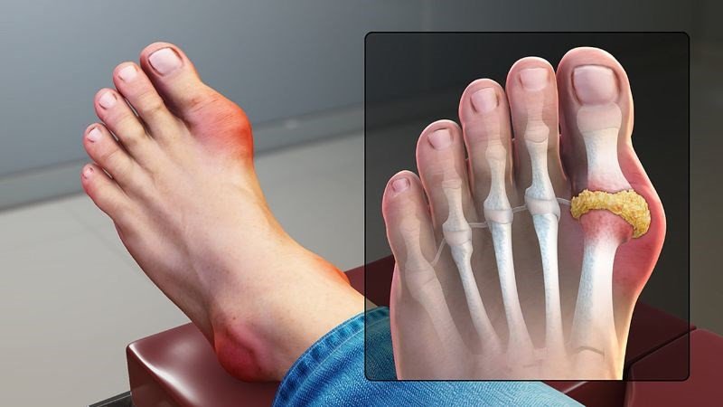 Chất xơ hòa tan trong cải ngọt có thể hỗ trợ điều trị bệnh gout hiệu quả