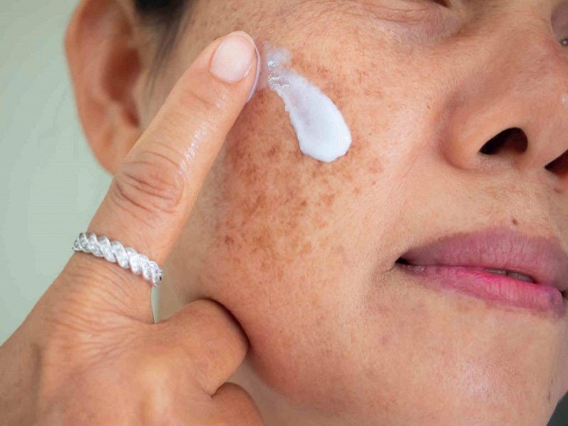 Chữa bớt nâu bằng thuốc bôi