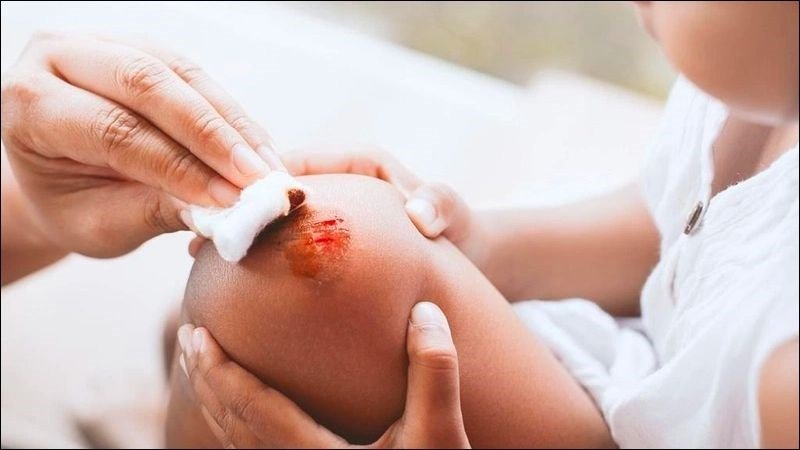 Củ mì không làm mưng mủ vết thương như nhiều người vẫn nghĩ