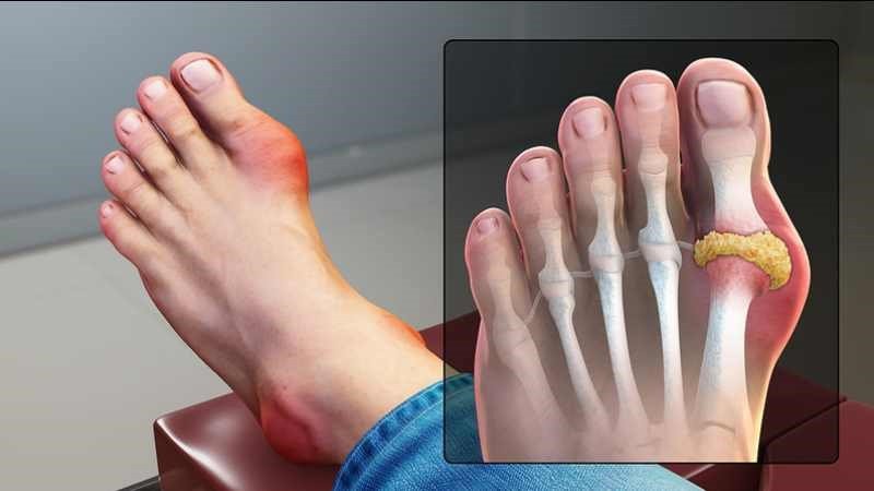 Đối tượng cần hạn chế hoặc tránh ăn cá lóc để bảo vệ sức khỏe