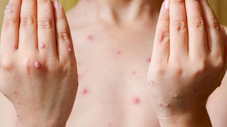 Đối tượng nên tránh ăn phao câu gà, đặc biệt là những người quan tâm đến việc phao câu gà bao nhiêu calo và các bệnh lý liên quan.