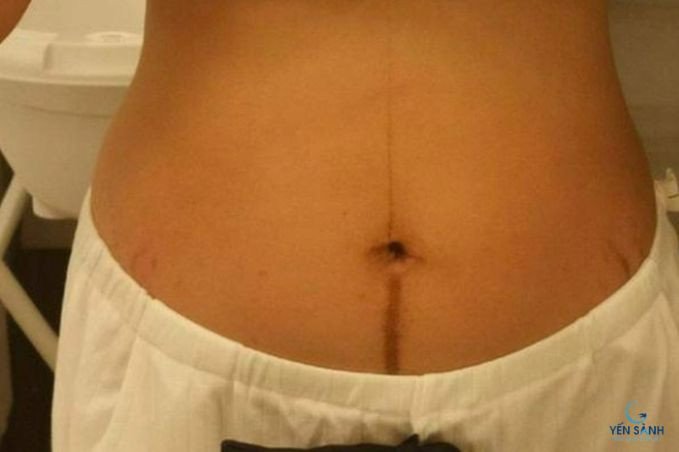 Đường sọc nâu Linea Nigra rõ nét trên bụng bầu, một hiện tượng da phổ biến khi mang thai