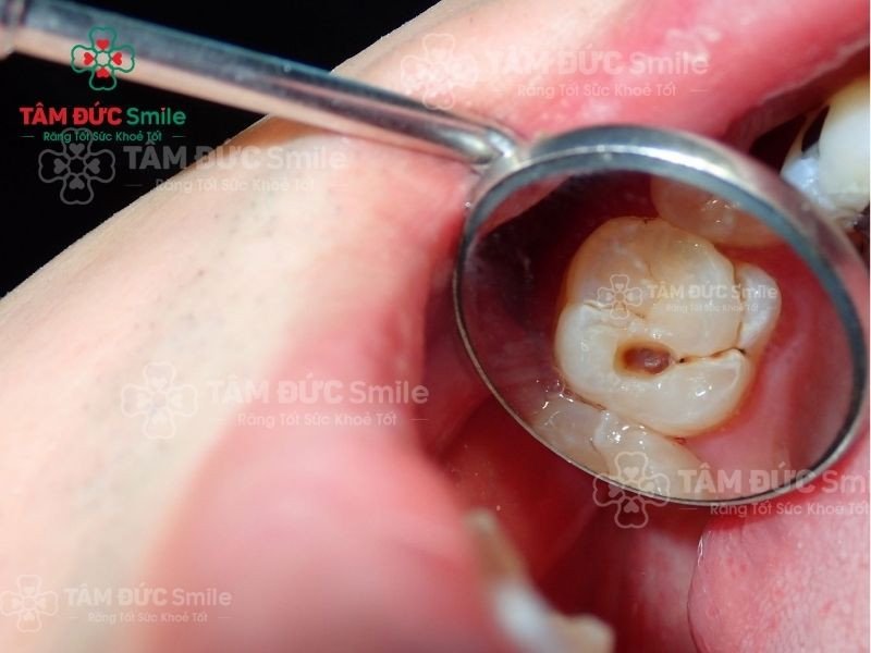 Hình ảnh minh họa răng bị sâu, một trong những nguyên nhân phổ biến gây hôi miệng