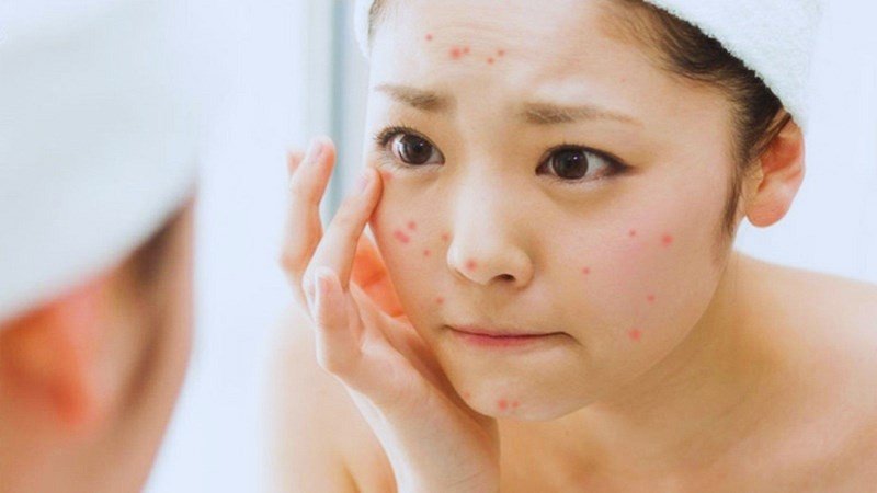 Khuôn mặt người phụ nữ có mụn trứng cá, cảnh báo tác hại khi ăn quá nhiều bánh pía mini gây nóng trong.
