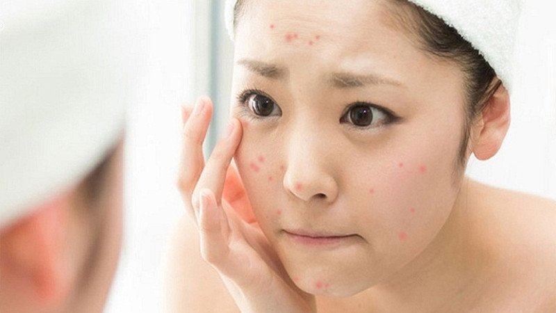 Mối liên hệ giữa việc tiêu thụ bánh mì và tình trạng mụn trứng cá