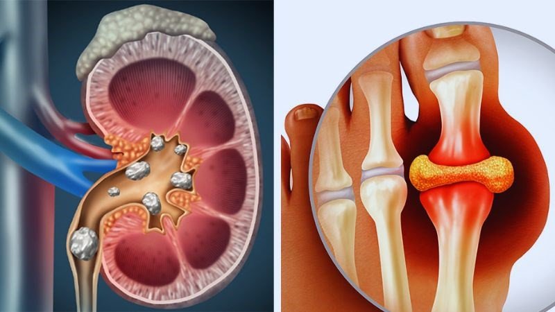 Ngoài đối tượng bị dị ứng, người bị bệnh sỏi thận và gout cũng không nên ăn khoai sọ