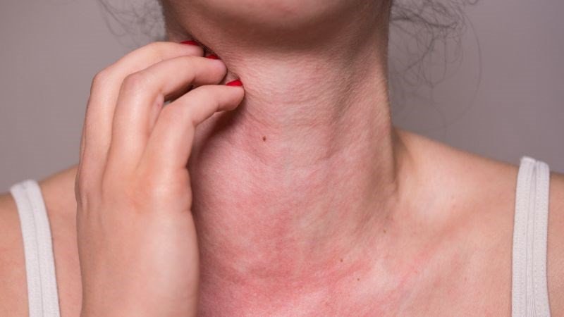 Người bị dị ứng với thịt gà