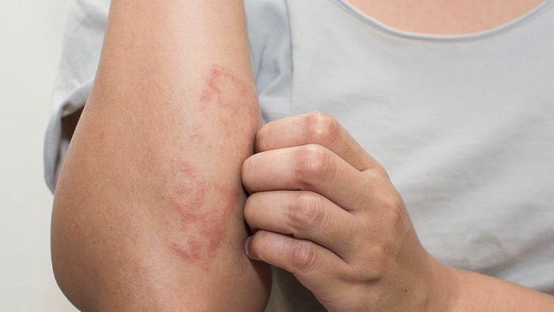 Người có cơ địa dị ứng với trứng gà cần thận trọng khi ăn