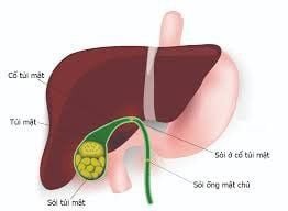 Nguy cơ sỏi mật khi giảm cân quá nhanh bằng chế độ ăn 1200 calo.