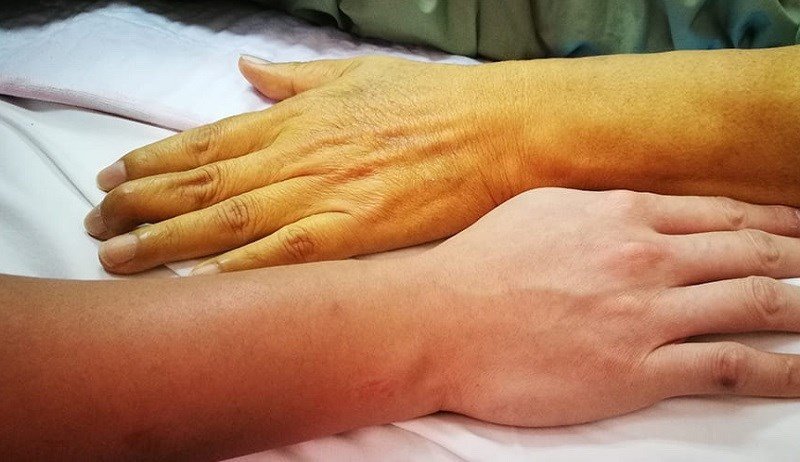Phản ứng dị ứng khi ăn cà chua