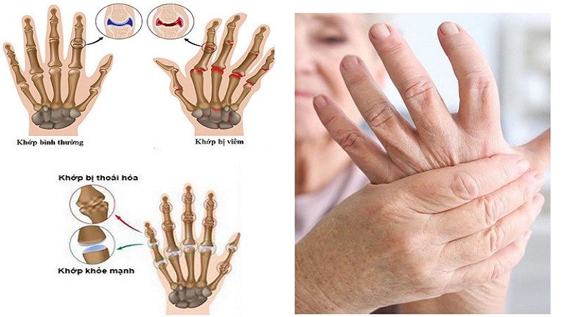 Rau càng cua có lợi cho xương khớp