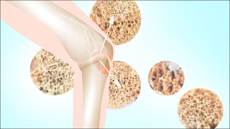Uống bia điều độ giúp hạn chế nguy cơ loãng xương