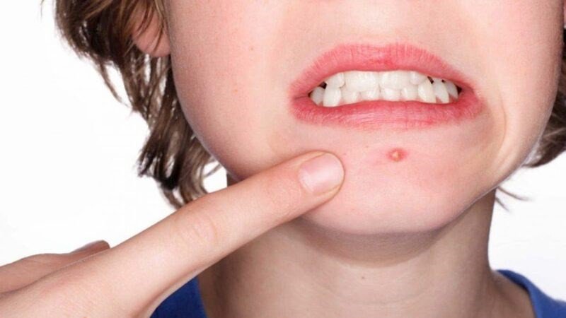 Gói mì tôm bên cạnh gương mặt có mụn, minh họa mối liên hệ giữa chế độ ăn và tình trạng da